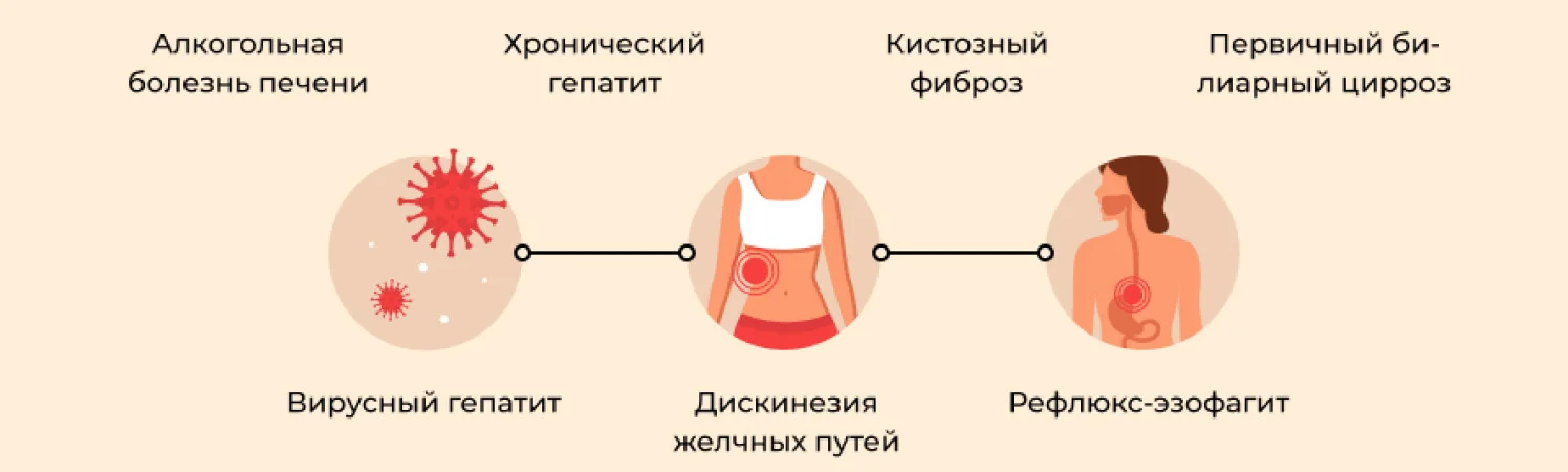 Урсосан при холецистите